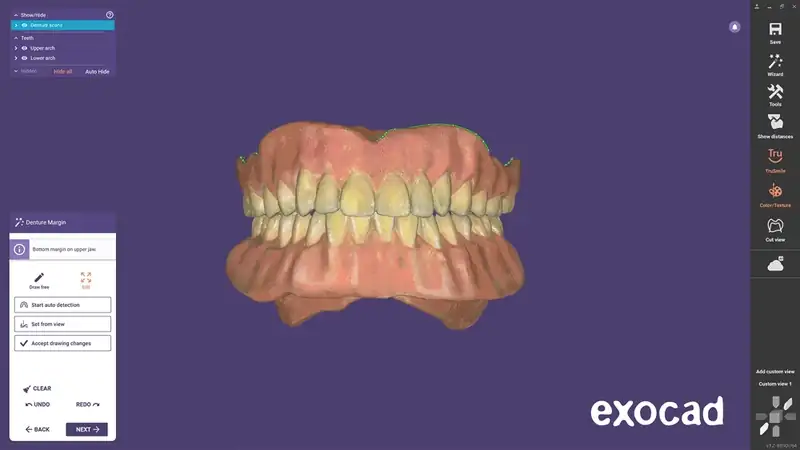 Designing a denture in exocad DentalCAD